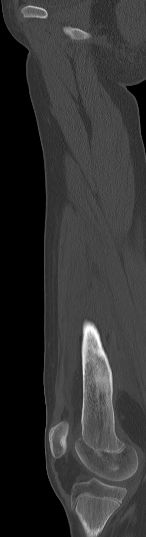 Chronic ostemyelitis of the femur with long sinus tract (Radiopaedia 74947-85982 Sagittal bone window 60).jpg