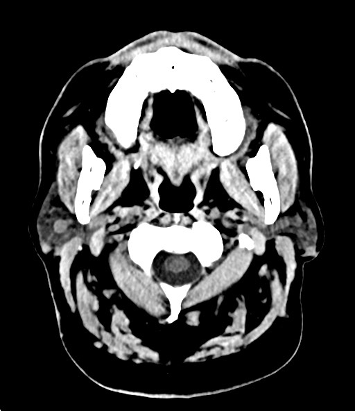 File:Chronic osteomyelitis - calvarial (severe) (Radiopaedia 69668-79616 Axial 117).jpg