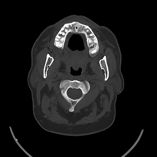 File:Chronic osteomyelitis - calvarial (severe) (Radiopaedia 69668-79616 Axial bone window 17).jpg