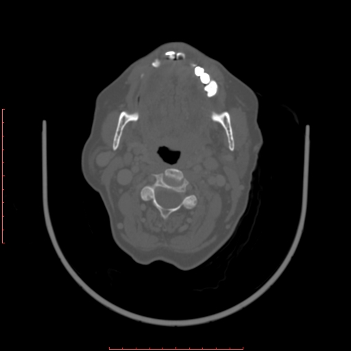 Chronic osteomyelitis - maxilla (Radiopaedia 23783-23927 Axial bone window 47).jpg