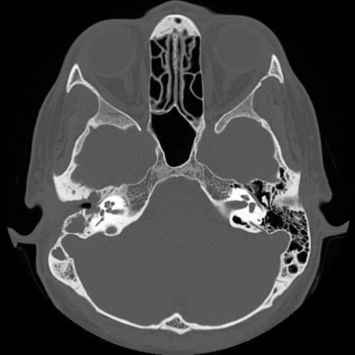 File:Chronic otomastoiditis (Radiopaedia 27138-27309 Axial bone window 33).jpg