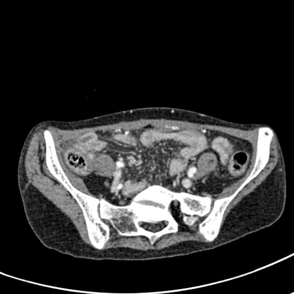 File:Chronic pancreatitis (Radiopaedia 55405-61846 A 78).jpg