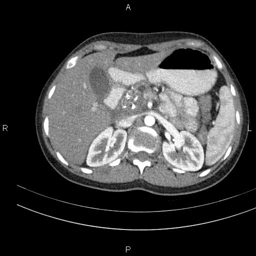 File:Chronic pancreatitis (Radiopaedia 64576-73450 B 43).jpg