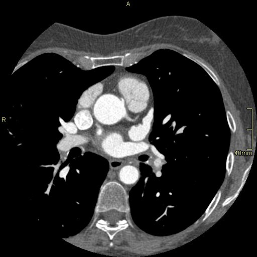 Chronic pulmonary embolism (Radiopaedia 73073-85094 Axial C+ CTPA 74).jpg