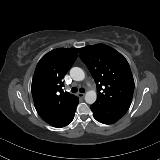 Chronic pulmonary embolus (Radiopaedia 39129-41341 Axial C+ CTPA 40).png