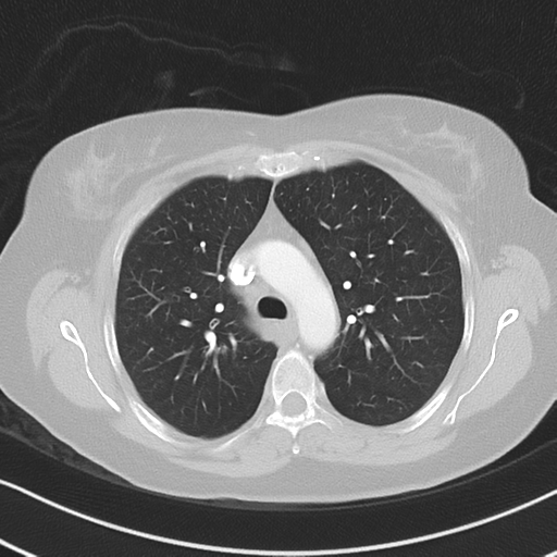 Chronic pulmonary embolus (Radiopaedia 39129-41341 Axial lung window 22).png