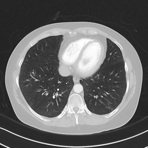 Chronic pulmonary embolus (Radiopaedia 39129-41341 Axial lung window 45).png
