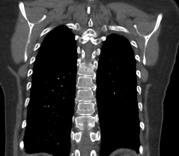 Chronic pulmonary embolus (Radiopaedia 39129-41341 Coronal C+ CTPA 67).png