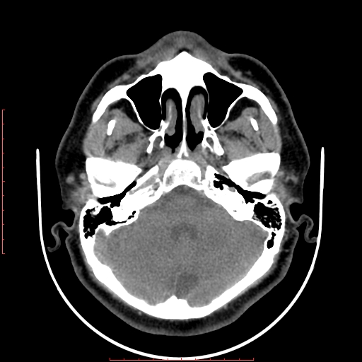 File:Chronic submandibular sialolithiasis (Radiopaedia 69817-79814 Axial non-contrast 7).jpg