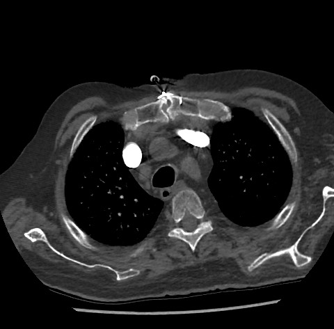Chronic thromboembolic pulmonary disease (Radiopaedia 90694-108119 Axial C+ CTPA 22).jpg