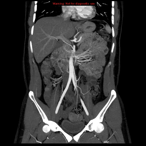 File:Circumaortic left renal vein (Radiopaedia 9069-9792 B 13).jpg