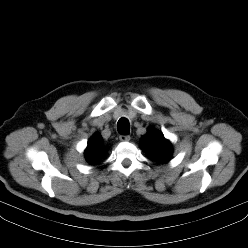 File:Classic complicated silicosis (Radiopaedia 49720-54961 Axial liver window 5).jpg