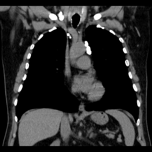 File:Classic complicated silicosis (Radiopaedia 49720-54961 Coronal liver window 27).jpg