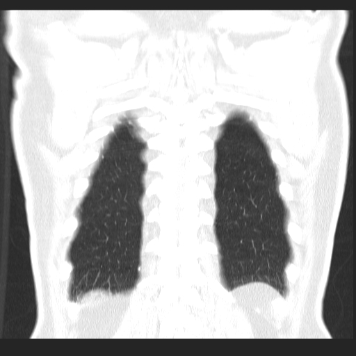 File:Classic complicated silicosis (Radiopaedia 49720-54961 Coronal lung window 56).jpg