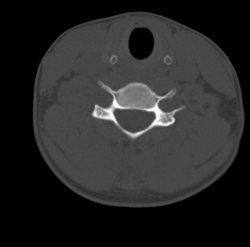 Clay-shoveler fracture (Radiopaedia 22568-22590 Axial bone window 49).jpg