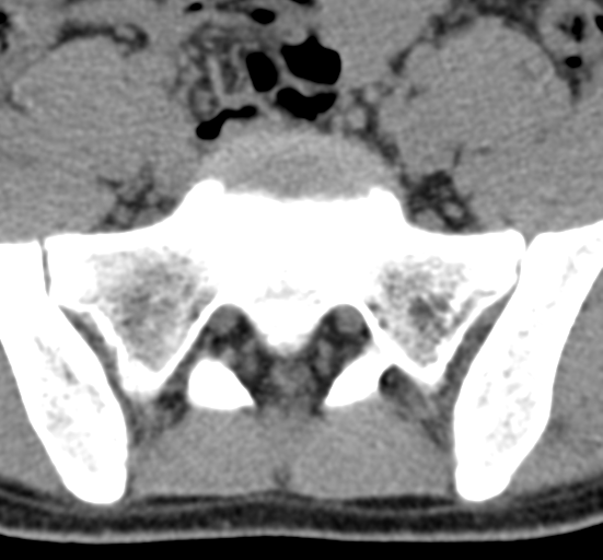File:Clear cell meningoma - lumbar spine (Radiopaedia 60116-67691 Axial non-contrast 70).png