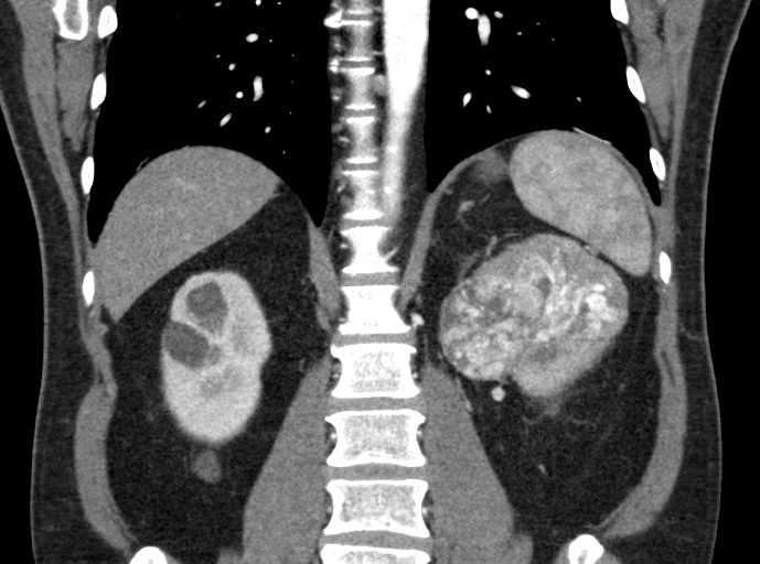 File:Clear cell renal cell carcinoma (Radiopaedia 61449-69393 C 31).jpg