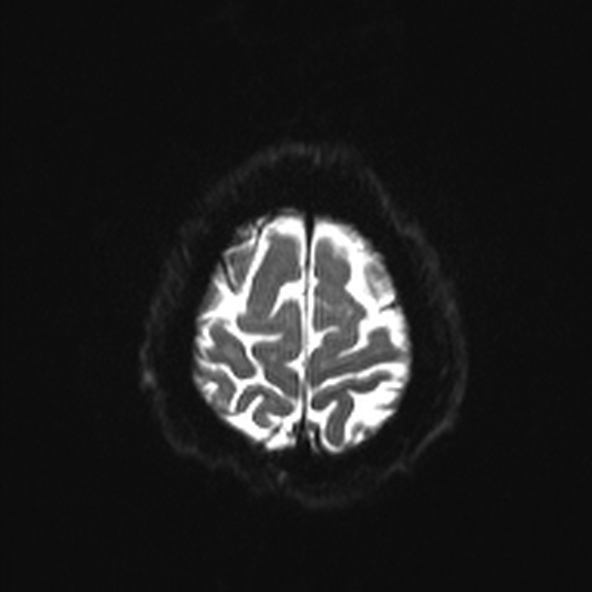 File:Clival meningioma (Radiopaedia 53278-59248 Axial DWI 23).jpg