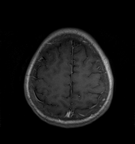 File:Clival meningioma (Radiopaedia 53278-59248 Axial T1 C+ 20).jpg