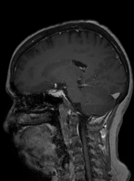 Clival meningioma (Radiopaedia 53278-59248 Sagittal T1 C+ 234).jpg