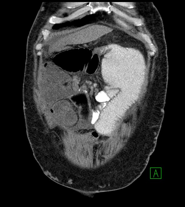 Closed-loop small bowel obstruction-internal hernia (Radiopaedia 78439-91096 Coronal non-contrast 25).jpg