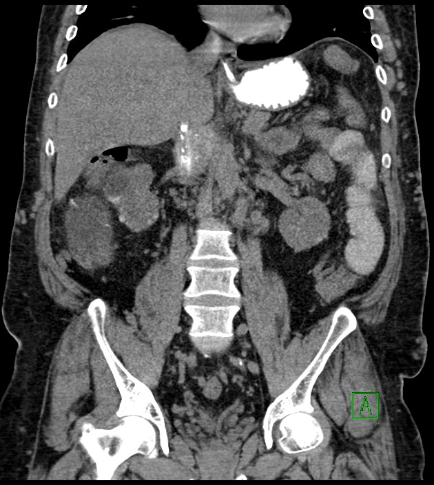 Closed-loop small bowel obstruction-internal hernia (Radiopaedia 78439-91096 Coronal non-contrast 59).jpg