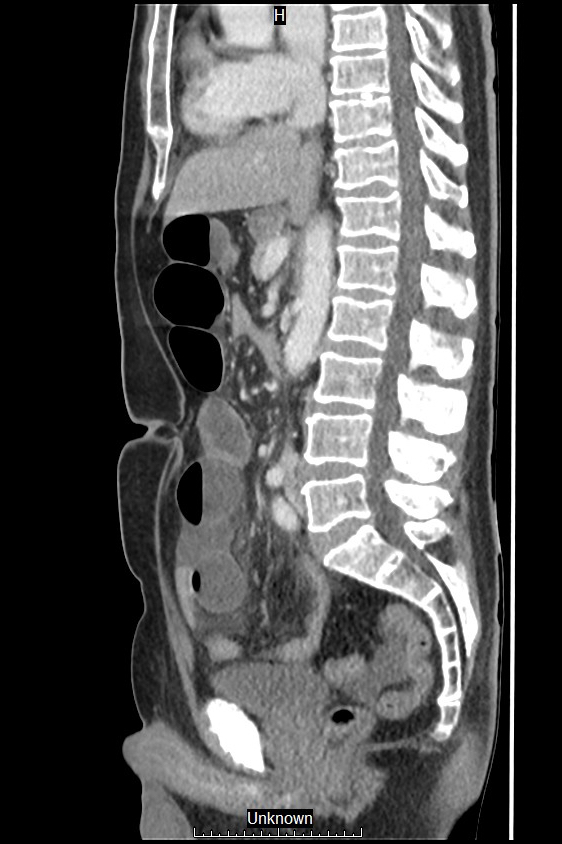 Closed loop bowel obstruction and ischemia (Radiopaedia 86959-103180 C 32).jpg