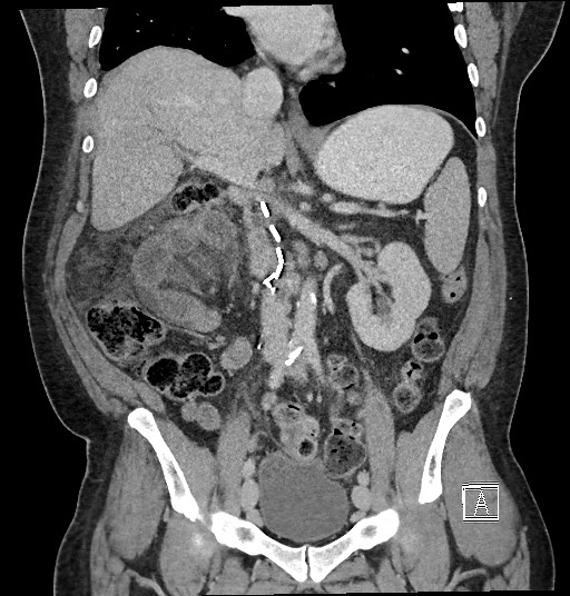 Closed loop obstruction - internal hernia into nephrectomy bed (Radiopaedia 59867-67320 B 70).jpg