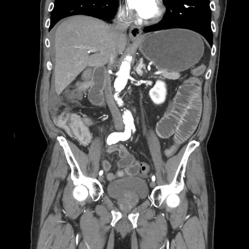 File:Closed loop obstruction due to adhesive band, resulting in small bowel ischemia and resection (Radiopaedia 83835-99023 C 64).jpg