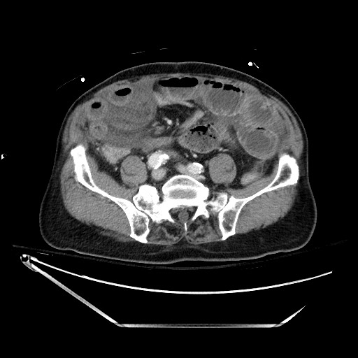 File:Closed loop obstruction due to adhesive band, resulting in small bowel ischemia and resection (Radiopaedia 83835-99023 D 106).jpg
