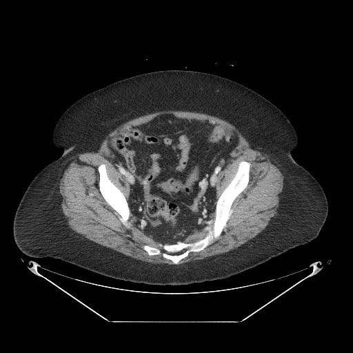 Closed loop small bowel obstruction - internal hernia (Radiopaedia 65402-74450 A 110).jpg