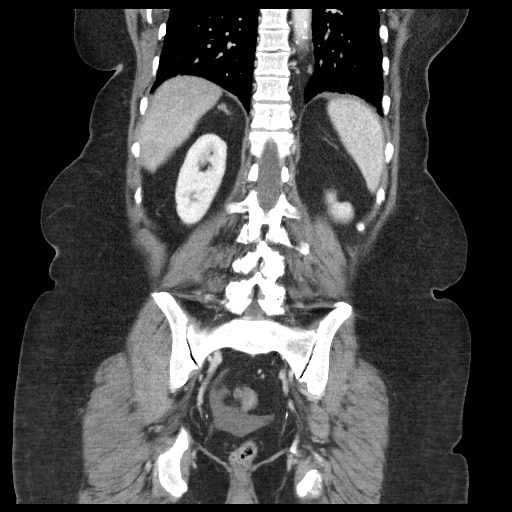 Closed loop small bowel obstruction - internal hernia (Radiopaedia 65402-74450 B 81).jpg