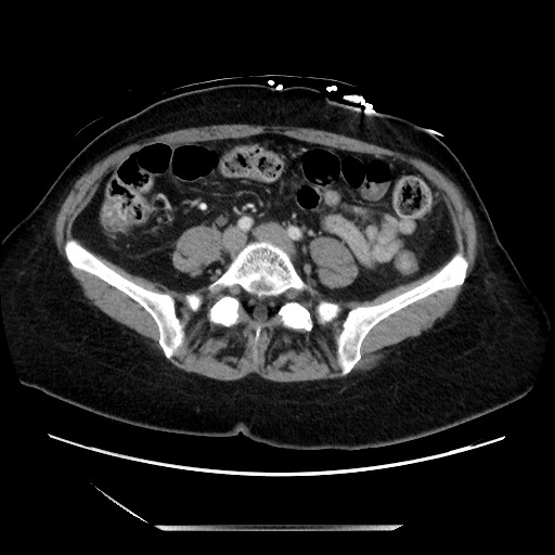 File:Closed loop small bowel obstruction due to adhesive bands - early and late images (Radiopaedia 83830-99014 A 98).jpg