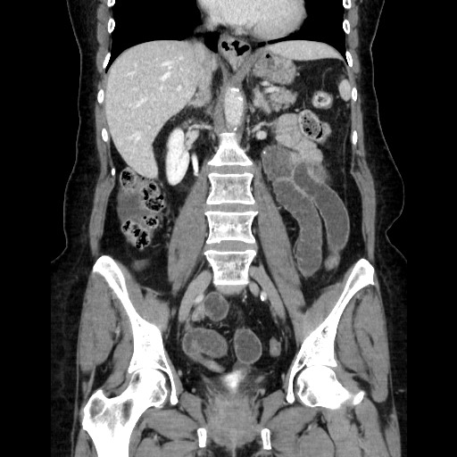 File:Closed loop small bowel obstruction due to adhesive bands - early and late images (Radiopaedia 83830-99015 B 70).jpg