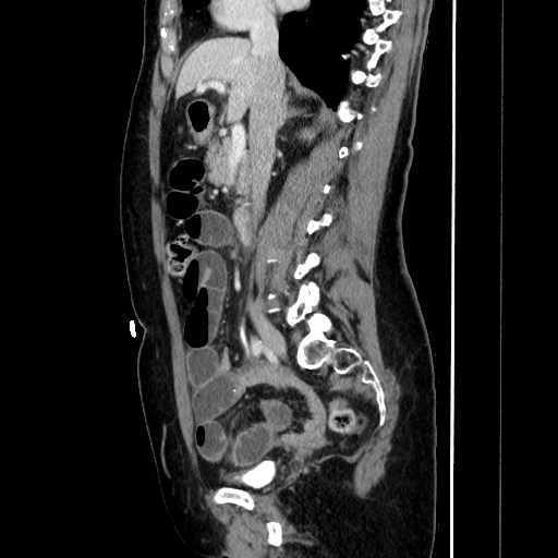 Closed loop small bowel obstruction due to adhesive bands - early and late images (Radiopaedia 83830-99015 C 80).jpg