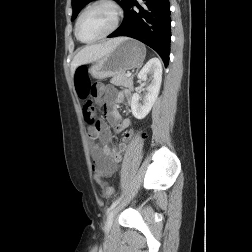 Closed loop small bowel obstruction due to trans-omental herniation (Radiopaedia 35593-37109 C 45).jpg