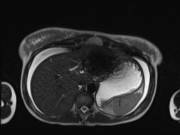 File:Closed loop small bowel obstruction in pregnancy (MRI) (Radiopaedia 87637-104031 Axial T2 14).jpg