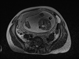 Closed loop small bowel obstruction in pregnancy (MRI) (Radiopaedia 87637-104031 D 16).jpg