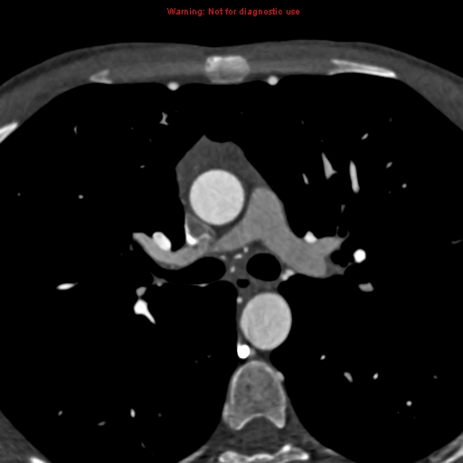 File:Coarctation of the aorta (Radiopaedia 12461-12697 A 173).jpg