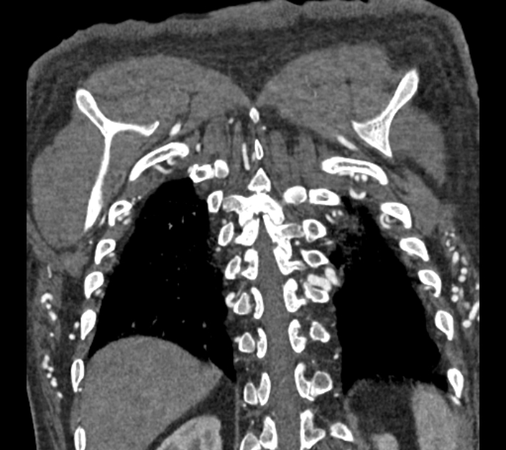 Coarctation of the aorta (Radiopaedia 53752-59822 B 71).jpg