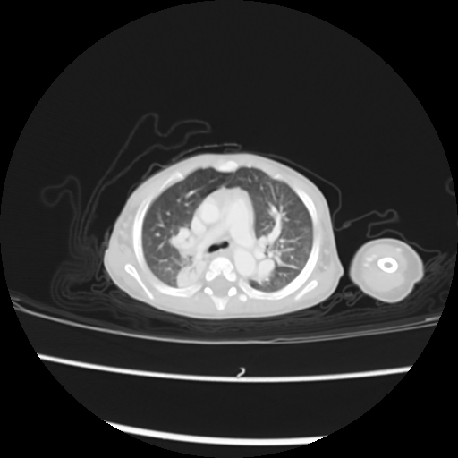 Coarctation of the aorta and patent ductus arteriosus (Radiopaedia 68033-77499 Axial lung window 18).jpg