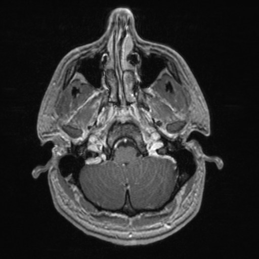 File:Colloid cyst (Radiopaedia 44510-48181 Axial T1 C+ 39).png