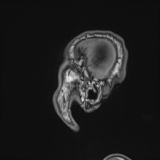 Colloid cyst of the third ventricle (Radiopaedia 86571-102662 Sagittal T1 5).png
