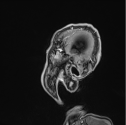 Colloid cyst of the third ventricle (Radiopaedia 86571-102662 Sagittal T1 C+ 73).png