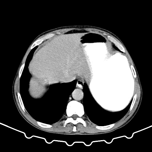 File:Colocolic intussusception due to large lipoma (Radiopaedia 68773-78482 A 14).jpg