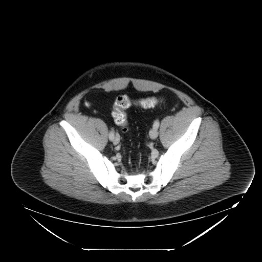 Colocolic intussusception due to lipoma (Radiopaedia 73712-84508 A 96).jpg