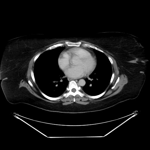 File:Colonic intussusception due to adenocarcinoma (Radiopaedia 86828-102987 A 5).jpg