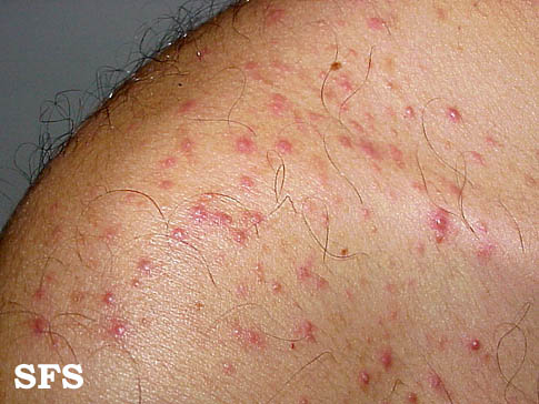 File:Folliculitis (Dermatology Atlas 3).jpg