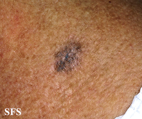 File:Melanoma (Dermatology Atlas 61).jpg