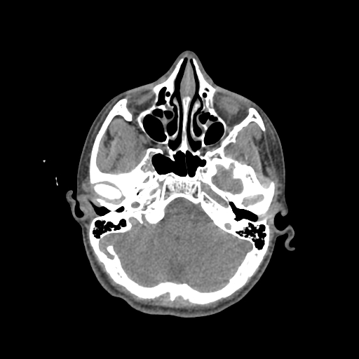 Nasal pyogenic granuloma (lobular capillary hemangioma) (Radiopaedia 85536-101244 Axial non-contrast 75).jpg